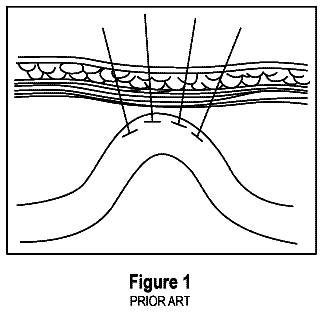 Drawing from US 11,213,461 B2