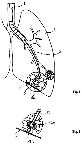 Drawing from US 11,229,476 B2