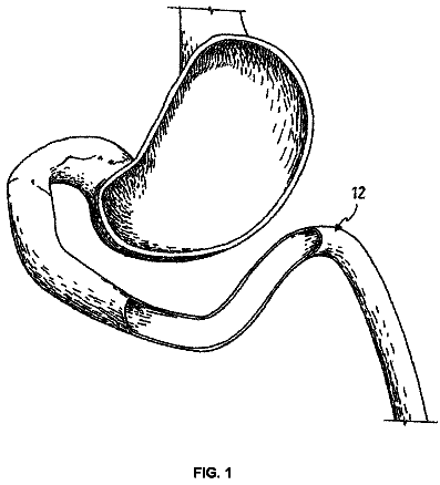 Drawing from US 8,540,739 B2