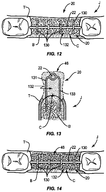Drawing sheet 6 of US 8,574,302 B2