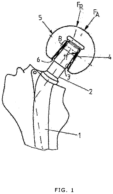 Drawing from US 8,574,307 B2