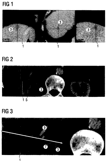 Drawing from US 8,623,006 B2