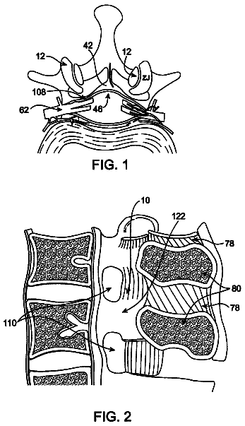 Drawing from US 8,647,346 B2