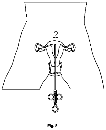 Drawing sheet 6 of US 8,690,892 B2