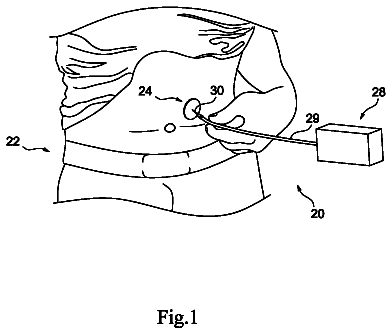 Drawing sheet 1 of US 8,784,389 B2