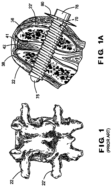 Drawing from US 9,743,961 B2