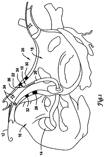 Drawing from US 9,750,556 B2