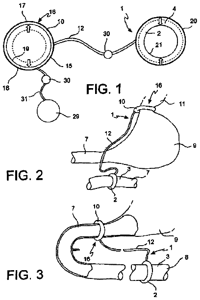 Drawing from US 9,750,660 B2
