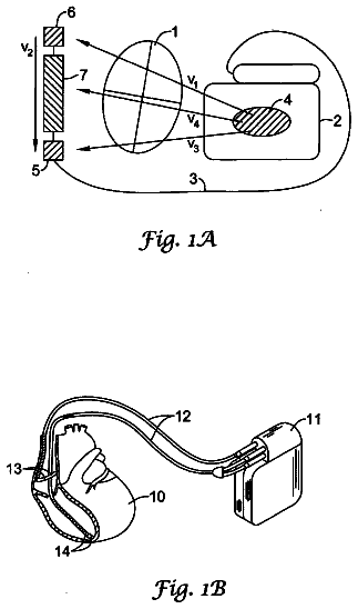 Drawing from US 9,764,152 B2