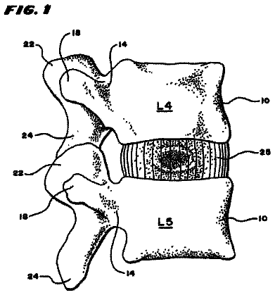 Drawing from US 9,974,660 B2