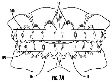 Drawing from US 9,987,103 B1