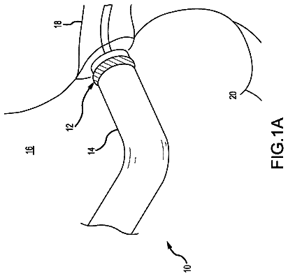 Drawing from US 9,999,718 B2